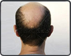 Androgenetic Alopecia