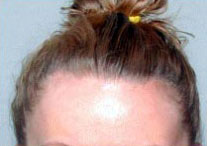 Hair Transplantation