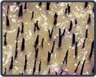 Follicular Unit Transplantation