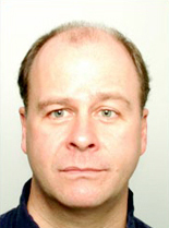 Hair Transplantation