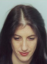 Hair Transplantation