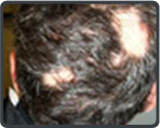 Temporary Hair Loss Treatment