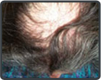 Permanent Hair Loss Treatment