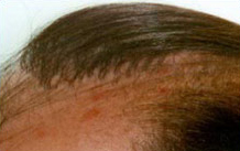 Previous Hair Restoration