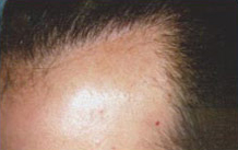 Previous Hair Restoration