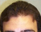 Late Teens Hairline