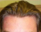 Mid 20's hairline