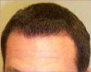 Early 30's hairline