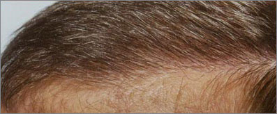 Transplanted Hairline