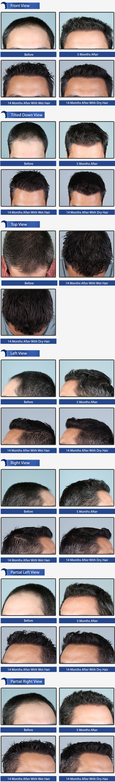 Follicular Unit Grafts Hair Transplant Surgery Toronto