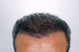 Hair Transplant