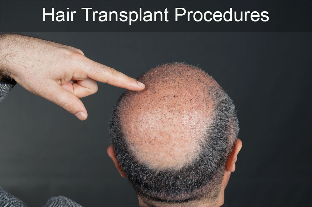 Follicular Unit Transplantation