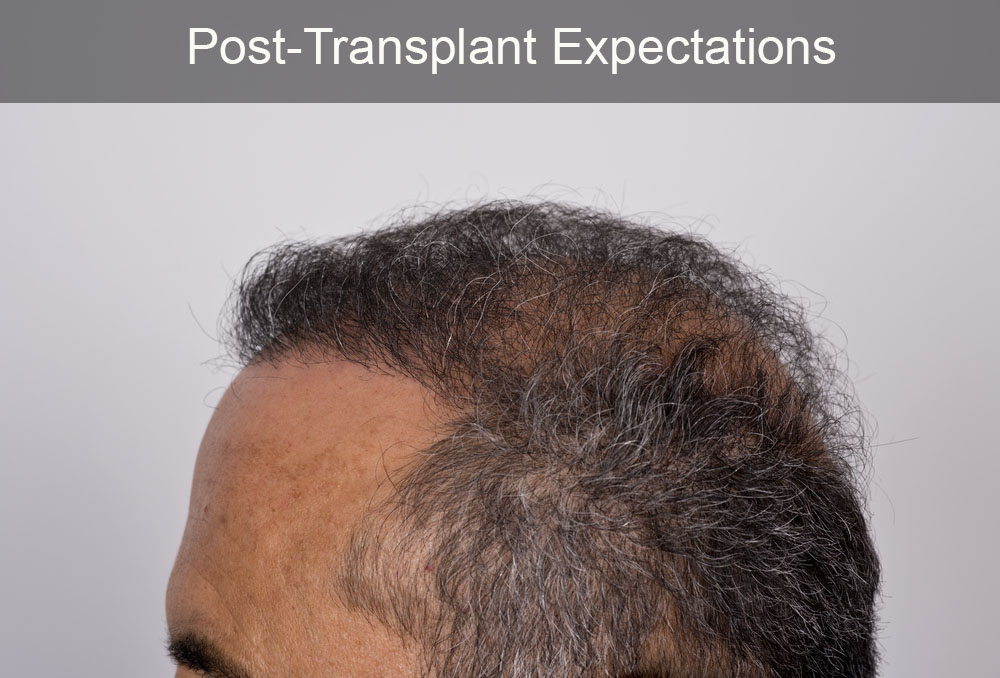 Hair Transplantation