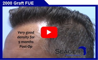 2000 Graft FUE Hair Transplant Client Results Video