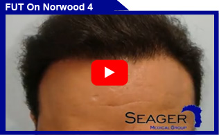 Strip (FUT) Hair Transplant on Norwood 4 hair loss pattern Client Results Video