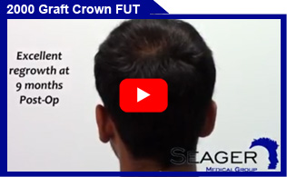 2000 Graft Strip FUT Crown Hair Transplant Client Results Video