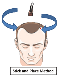 Stick and place hair graft implantation method