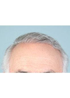After Hair Transplant&nbsp;Hairlines