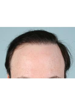 After Hair Transplant&nbsp;Revision