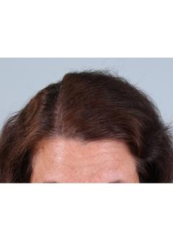 After Hair Transplant&nbsp;Hair Thinning