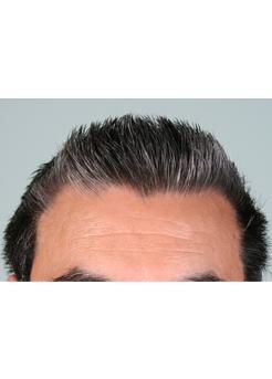 After Hair Transplant&nbsp;Temporal Hairline