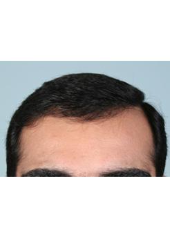 After Hair Transplant&nbsp;Front