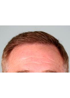 After Hair Transplant&nbsp;Front