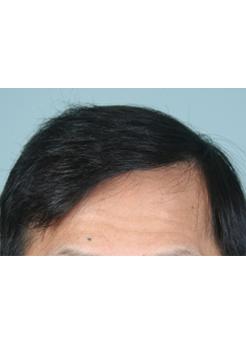 After Hair Transplant&nbsp;2 Sessions (Areas)
