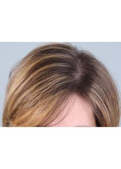 After Hair Transplant&nbsp;Hair Thinning