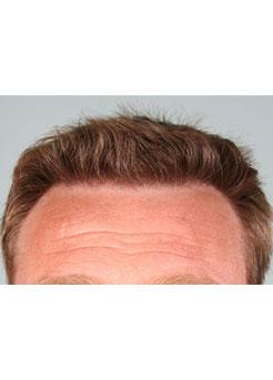 After Hair Transplant&nbsp;Hairlines