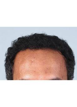 After Hair Transplant&nbsp;Hairlines