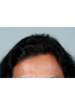After Hair Transplant&nbsp;Hair Thinning