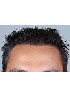 After Hair Transplant&nbsp;Front