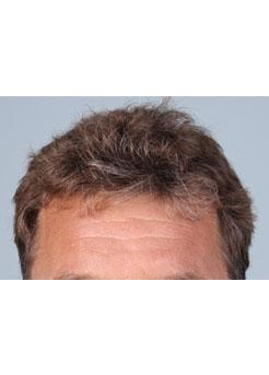 After Hair Transplant&nbsp;Hairlines
