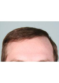 After Hair Transplant&nbsp;Hairlines