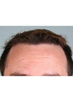 After Hair Transplant&nbsp;Hairlines
