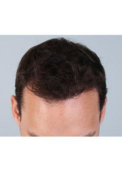 After Hair Transplant&nbsp;Hairlines