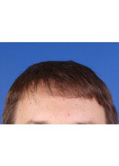 After Hair Transplant&nbsp;Front