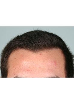 After Hair Transplant&nbsp;Hairlines