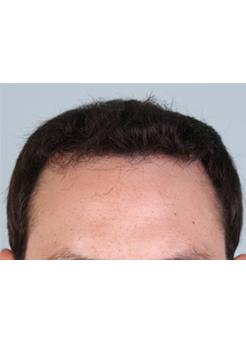 After Hair Transplant&nbsp;Front