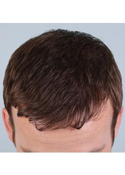 After Hair Transplant&nbsp;Front