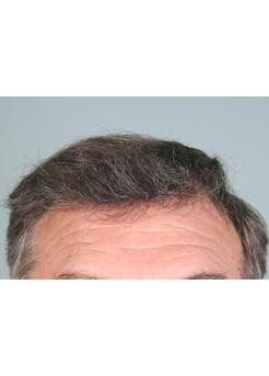 After Hair Transplant&nbsp;Front