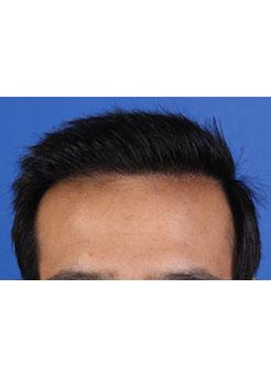 After Hair Transplant&nbsp;Front
