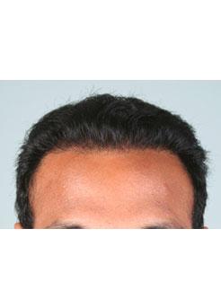 After Hair Transplant&nbsp;Hairlines