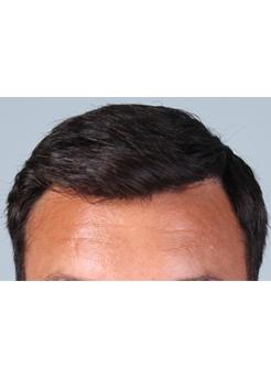 After Hair Transplant&nbsp;Front