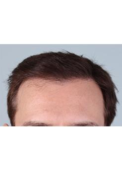 After Hair Transplant&nbsp;Front