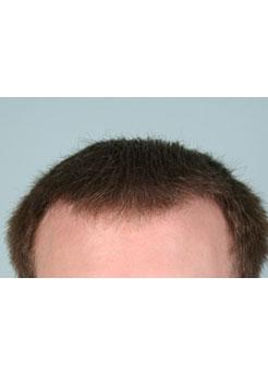 After Hair Transplant&nbsp;Front