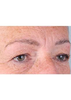 After Hair Transplant&nbsp;Eyebrows