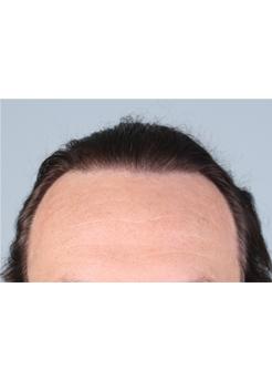 After Hair Transplant&nbsp;Temporal Hairline