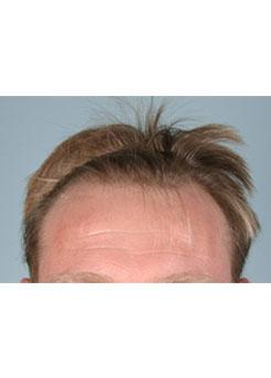 Before Hair Transplant&nbsp;Hairlines